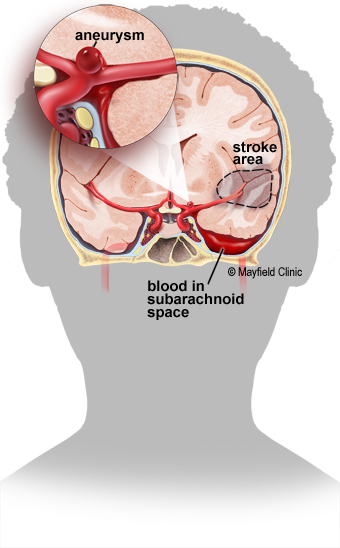 Figure 1. aneurysm