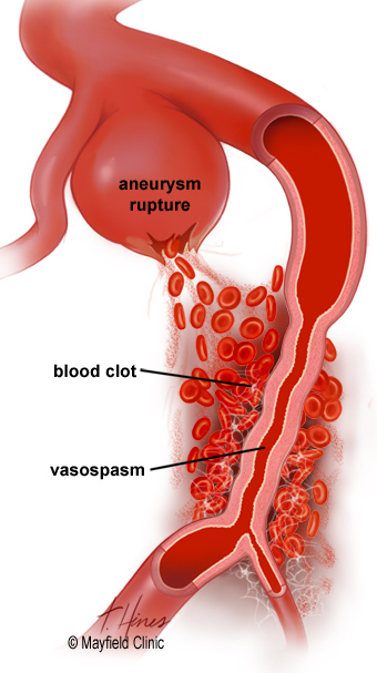 Figure 2. aneurysm rupture