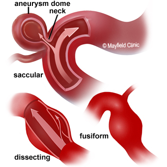 aneurysm types
