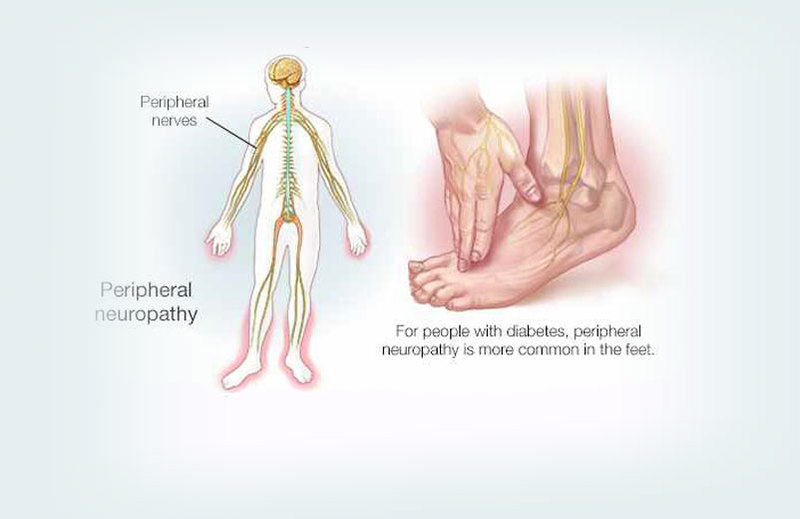 Невропатия конечностей: Доступный способ лечения