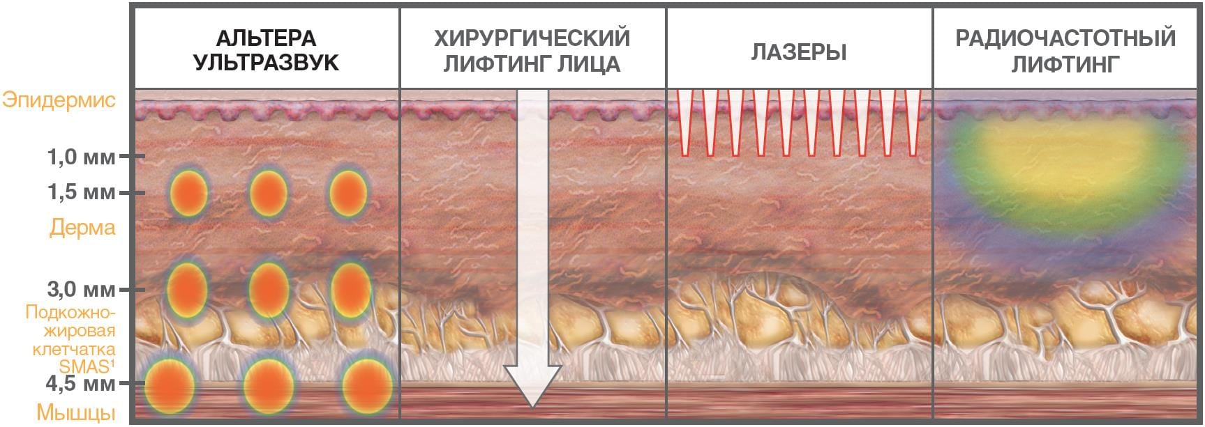 Эффективность Альтера лифтинга