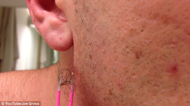 Joe Gross lines up the clump of ingrown hair on his neck with his tweezers 