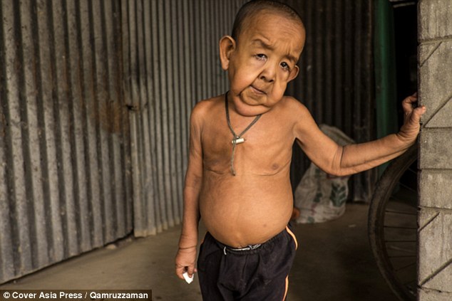 Bayezid Hossain, from southern Bangladesh is only four years old but resembles an old man due to a rare ageing disease