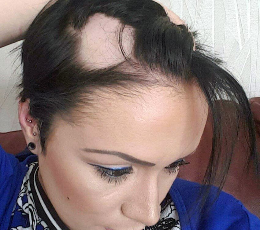 Симптом - выпадение волос